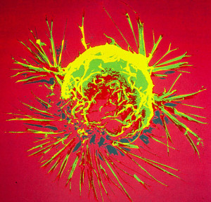 512px-Breast_cancer_cell_(1)